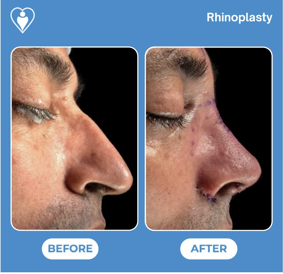 Rhinoplasty in Istanbul, before and after: a man's nose in profile before, and after surgery with surgical markings and stitches still visible, patient of Prof. Güven Güvenç, Flymedi.