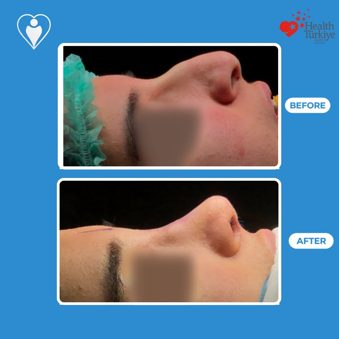 Nose surgery before and after: a patient's nose in profile on the operating table before, and straight after surgery with surgical markings on the skin, eyes blurred, patient of Prof. Güven Güvenç, Flymedi.