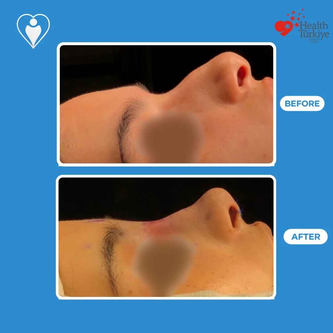 Nose job in Turkey, before and after: a patient's nose in profile before, and straight after surgery with a reshaped bridge and stitches at the nostril, eyes blurred, patient of Prof. Güven Güvenç, Flymedi.
