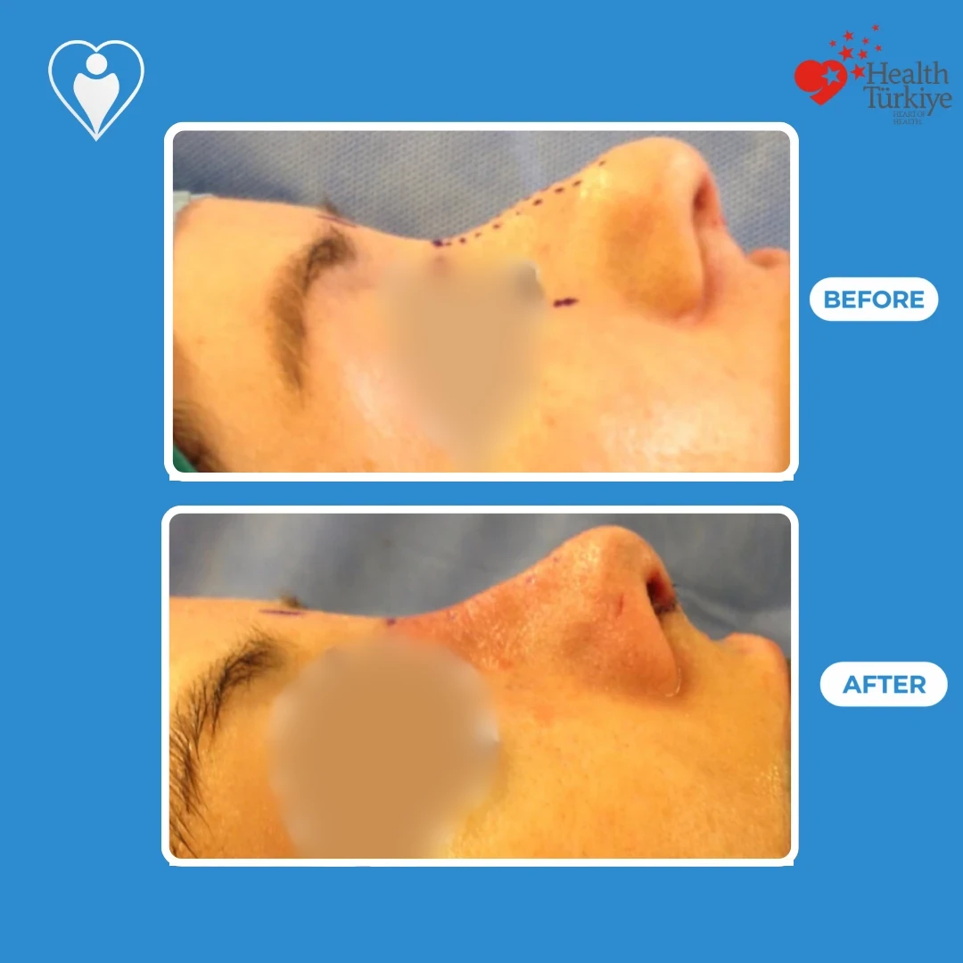 Rhinoplasty results: a patient's nose in profile with the planned new line drawn on the bridge before, and straight after surgery with a straighter bridge, eyes blurred, patient of Prof. Güven Güvenç, Flymedi.