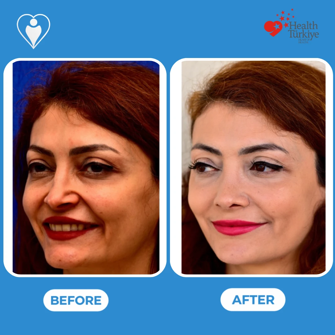 Rhinoplasty before and after photos: a smiling woman with red hair seen from the side before, and with a smaller, refined nose after, patient of Prof. Güven Güvenç, Flymedi.