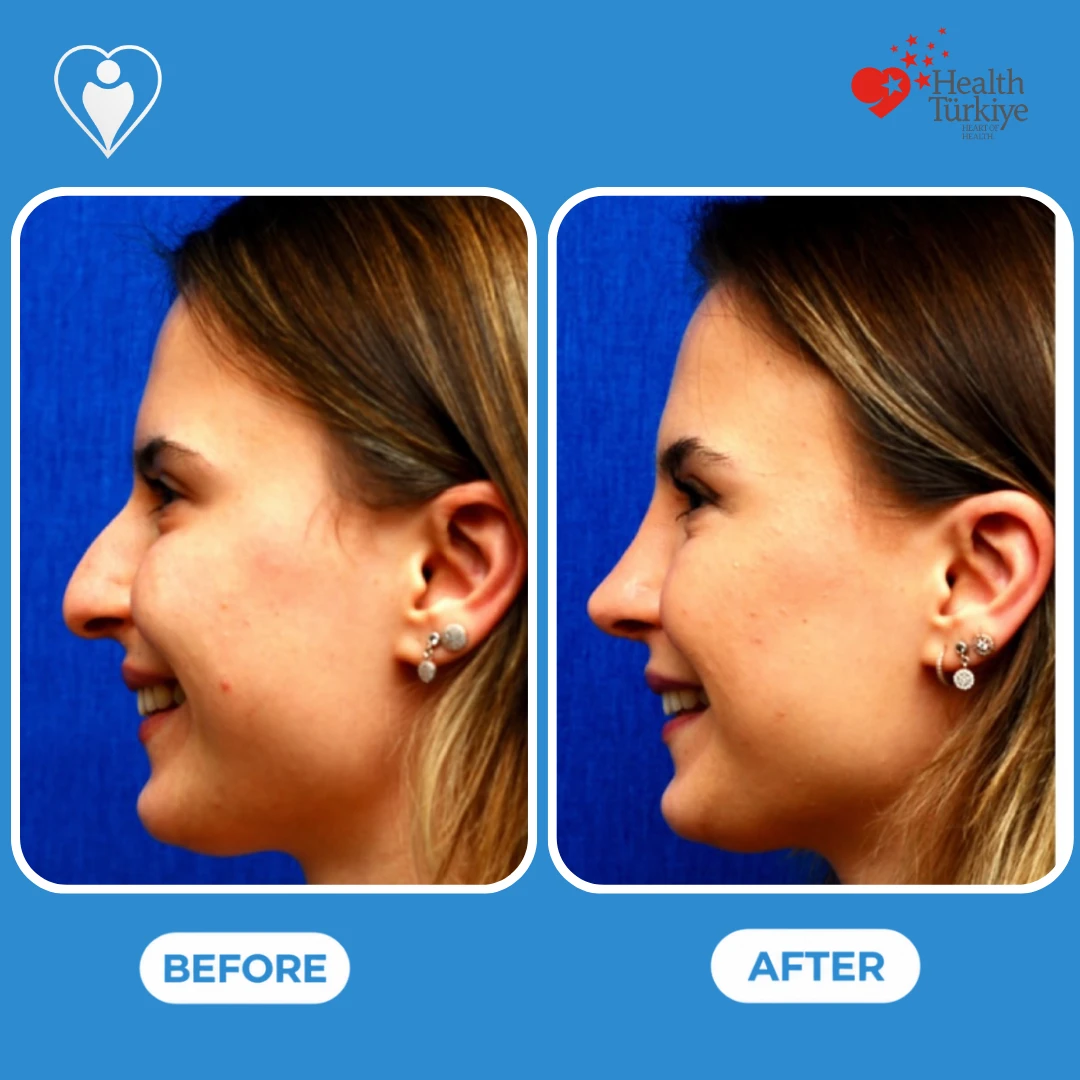 Nose job results: a smiling young woman with earrings in profile before, and with a straighter nose bridge after, patient of Prof. Güven Güvenç, Flymedi.