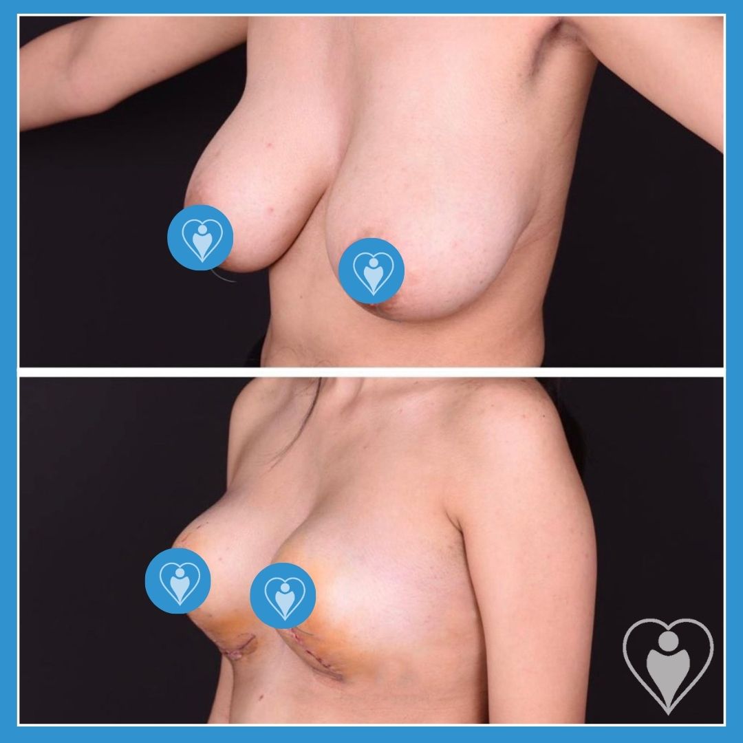 Breast lift before and after: a woman's front view before, and with a lifted breast contour after, patient of Dr. Hakkı İzmirli, Flymedi.