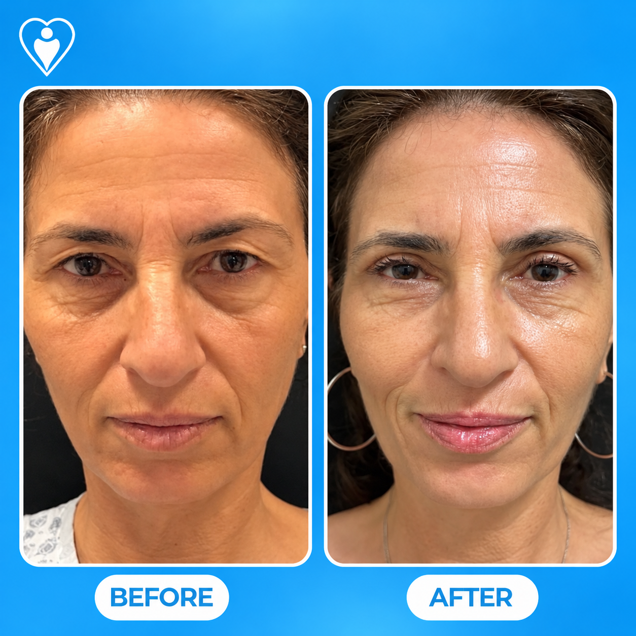 Lifting facial antes y después: la vista frontal de una mujer antes, y después del rejuvenecimiento facial, paciente de la Dra. Handan Şimşek Turan, Flymedi.