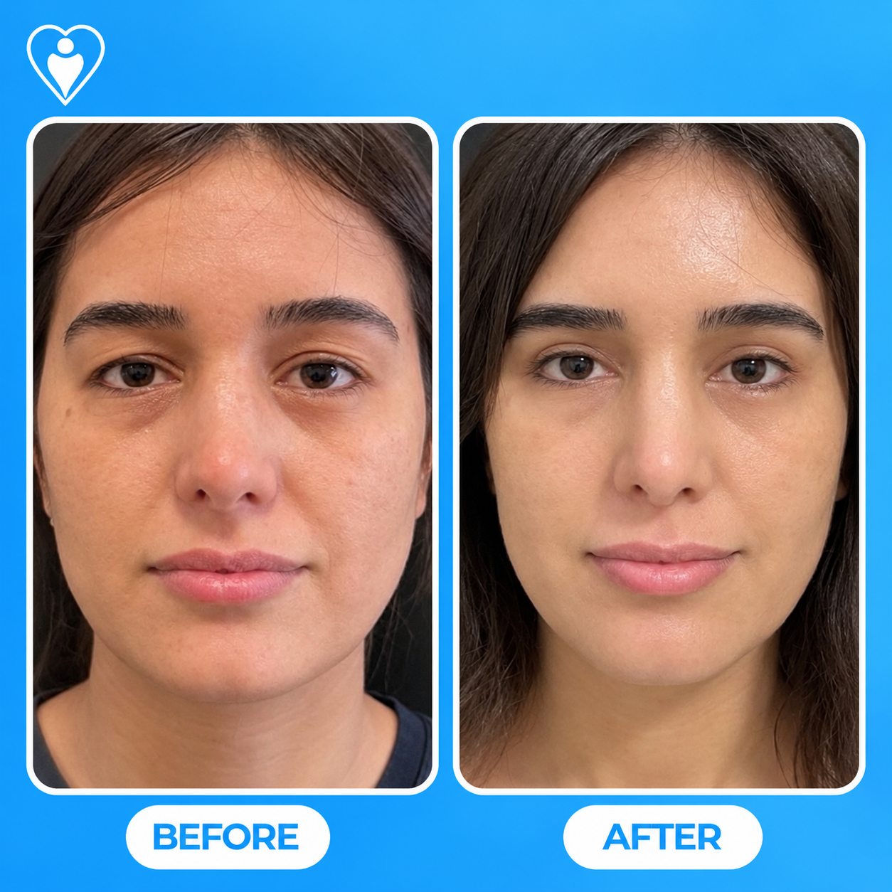 Rejuvenecimiento facial antes y después: la vista frontal de una mujer antes, y después de la cirugía de lifting facial, paciente de la Dra. Handan Şimşek Turan, Flymedi.