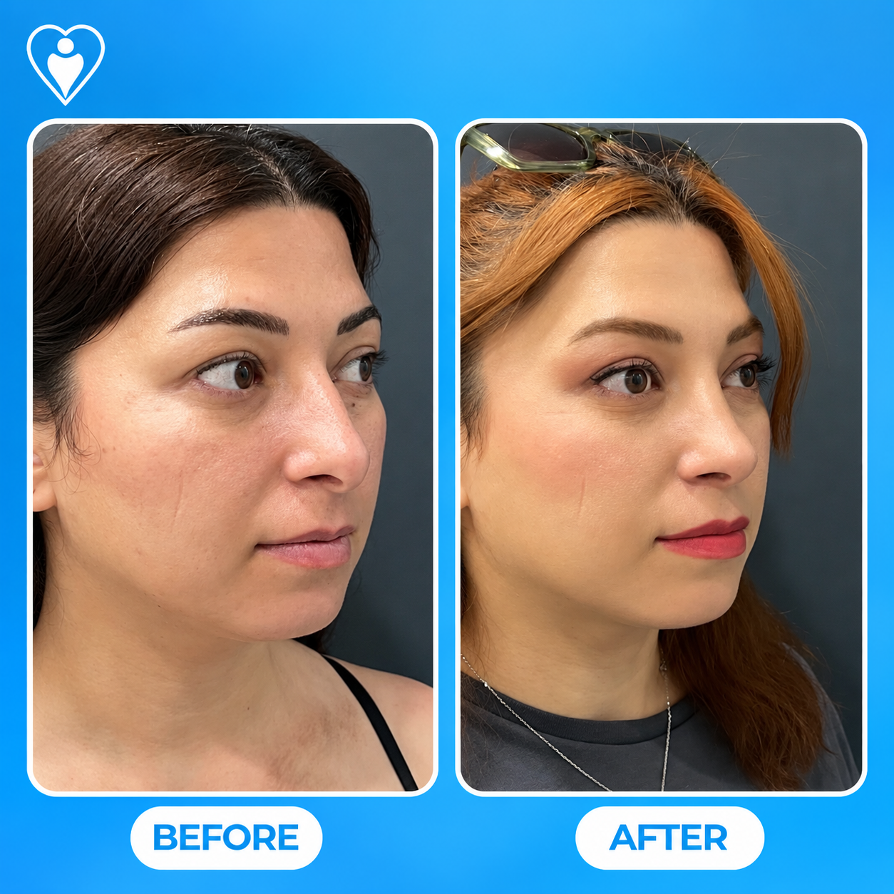 Rinoplastia antes y después: el perfil lateral de una mujer antes, y después de remodelar la nariz, paciente de la Dra. Handan Şimşek Turan, Flymedi.