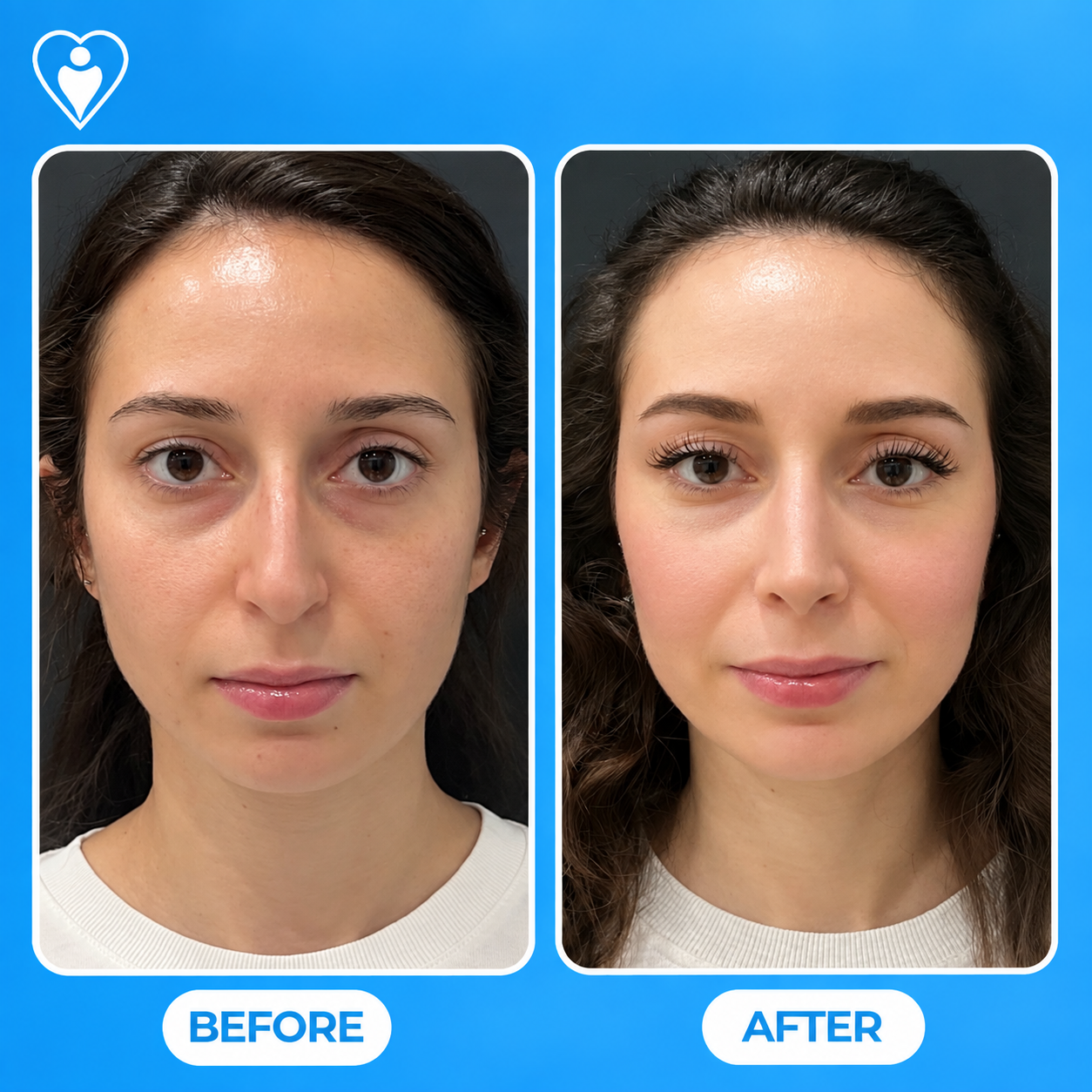 Lifting facial antes y después: la vista frontal de una mujer antes, y después de la cirugía de rejuvenecimiento facial, paciente de la Dra. Handan Şimşek Turan, Flymedi.