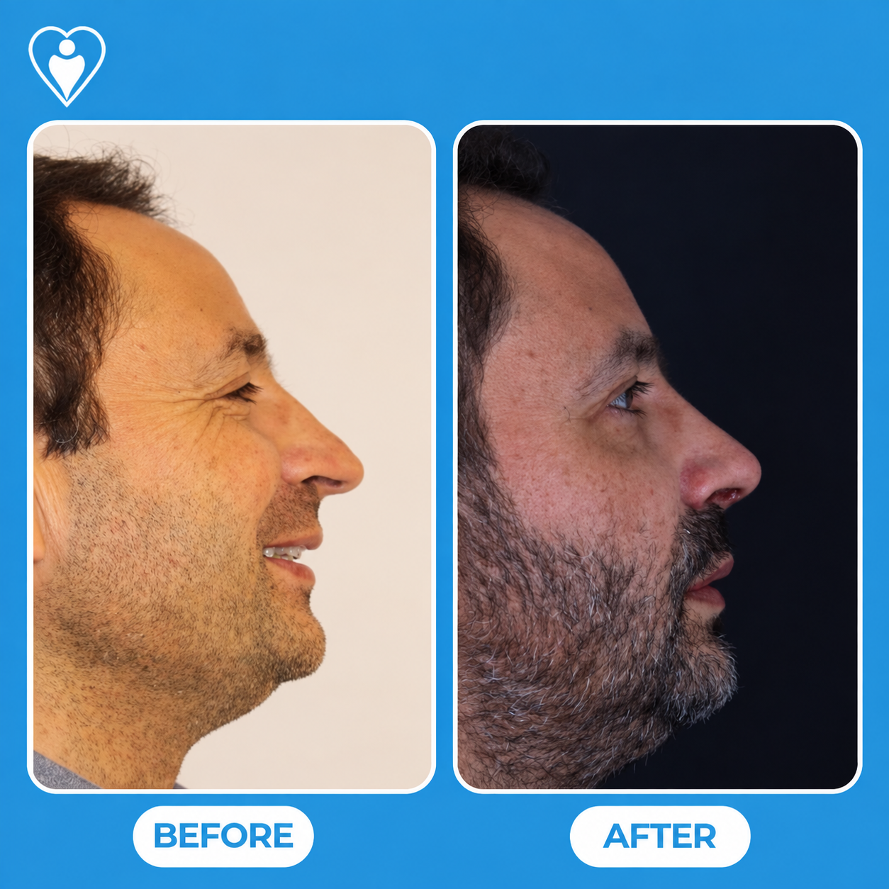 Rhinoplasty before and after: a smiling man's side profile before, and after nose reshaping, patient of Dr. Hasan Duygulu, Flymedi.