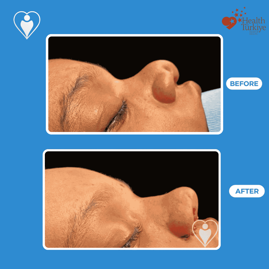 Nose reshaping surgery before and after: a woman's side profile before, and after rhinoplasty, patient of Dr. Hasan Duygulu, Flymedi.
