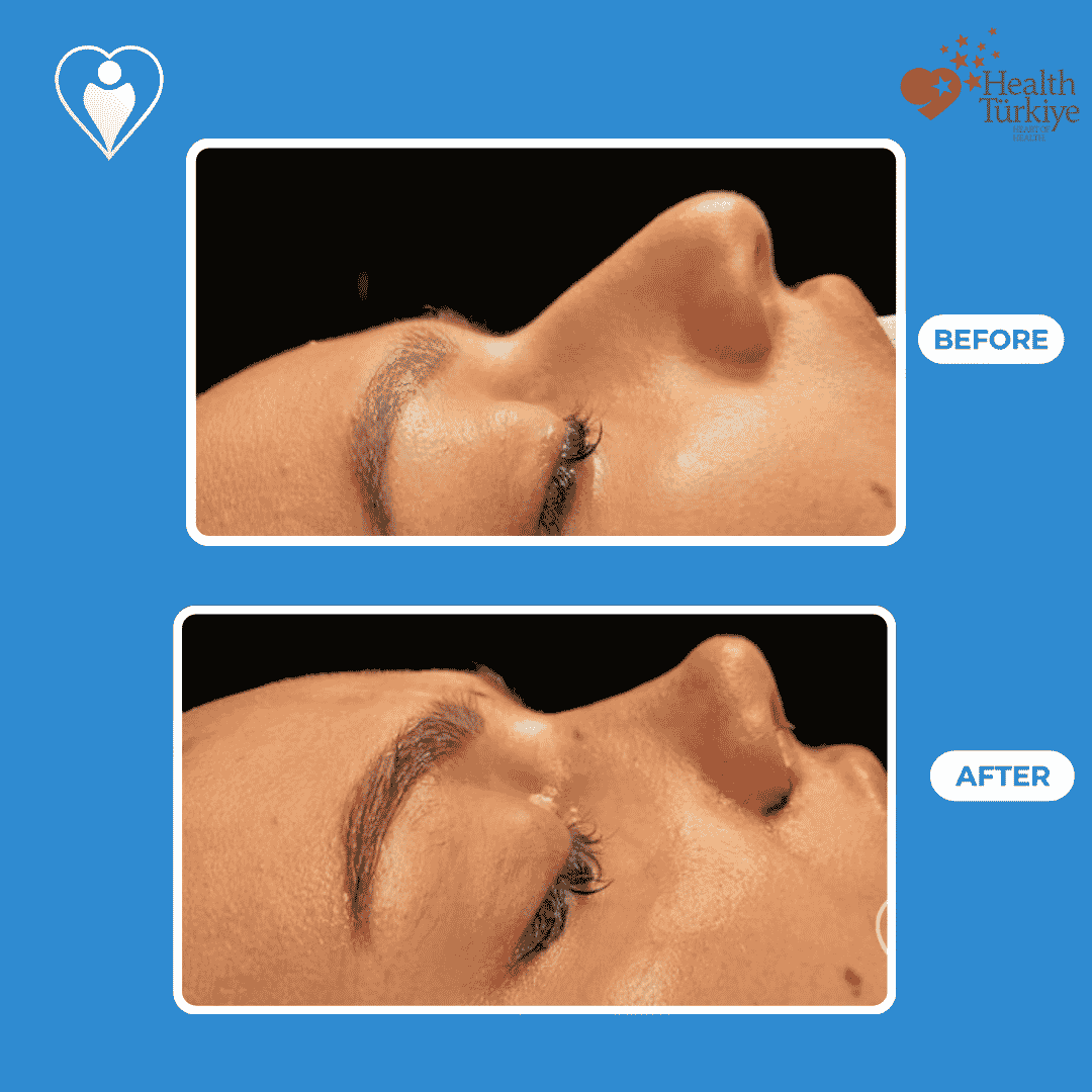 Rhinoplasty before and after: a woman's side profile before, and after nose surgery, patient of Dr. Hasan Duygulu, Flymedi.