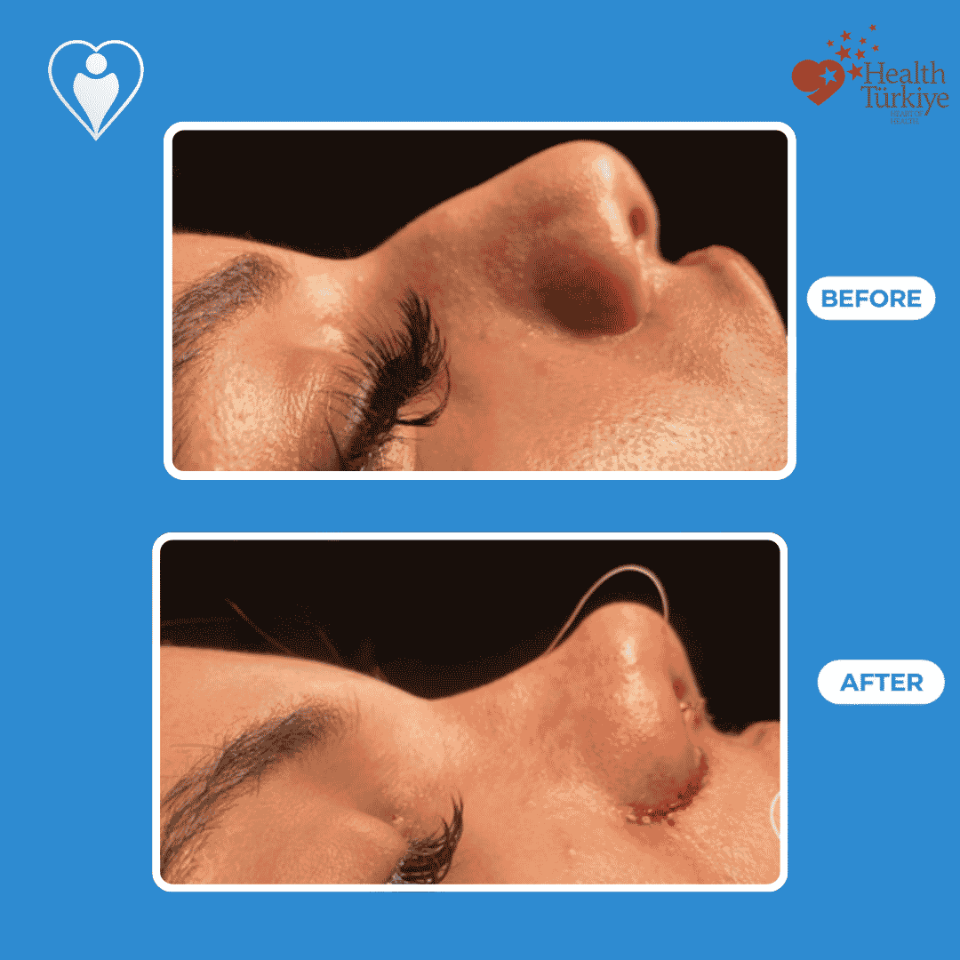 Nose surgery before and after: a woman's side profile before, and after rhinoplasty, patient of Dr. Hasan Duygulu, Flymedi.