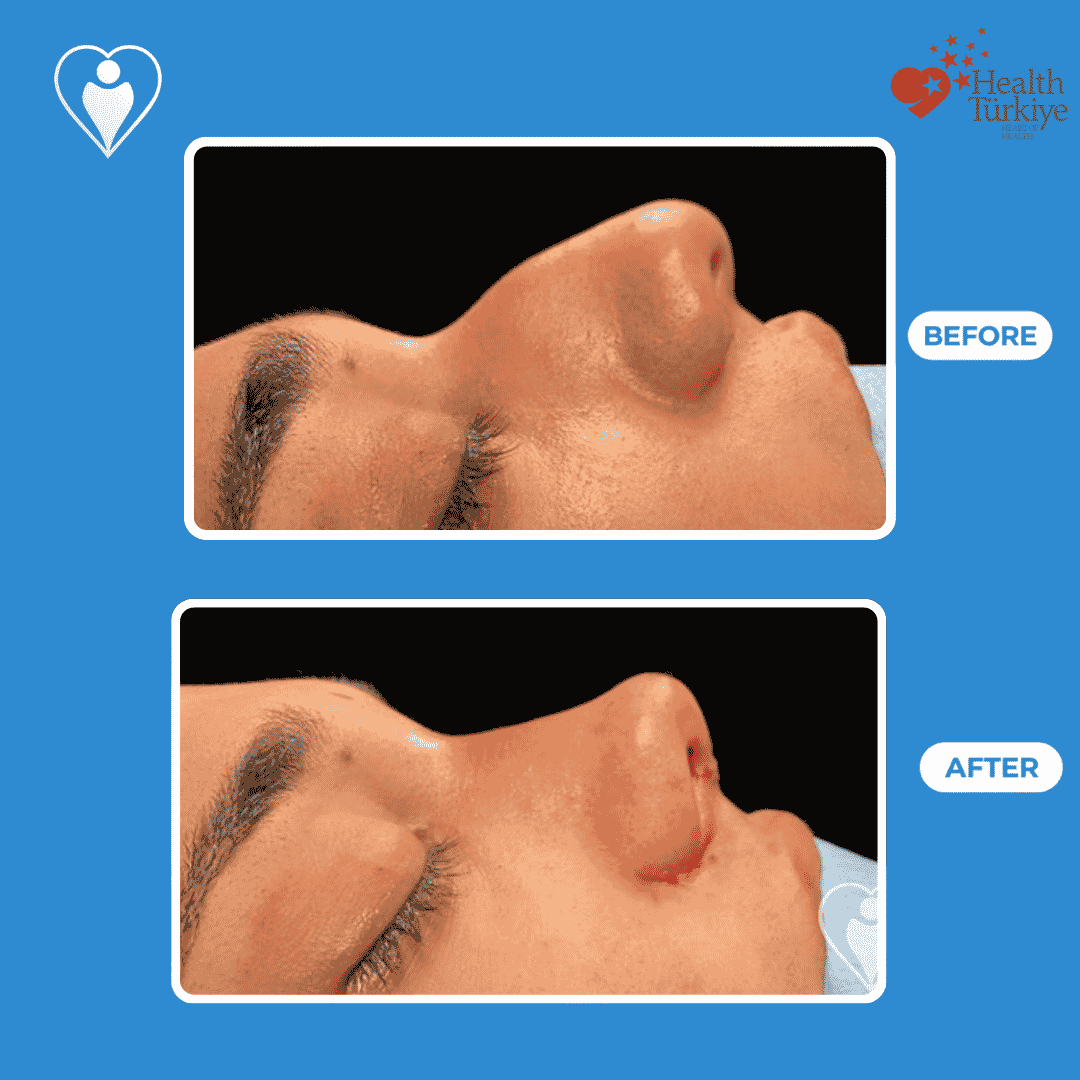 Rhinoplasty in Turkey, before and after: a woman's side profile before, and after nose reshaping, patient of Dr. Hasan Duygulu, Flymedi.