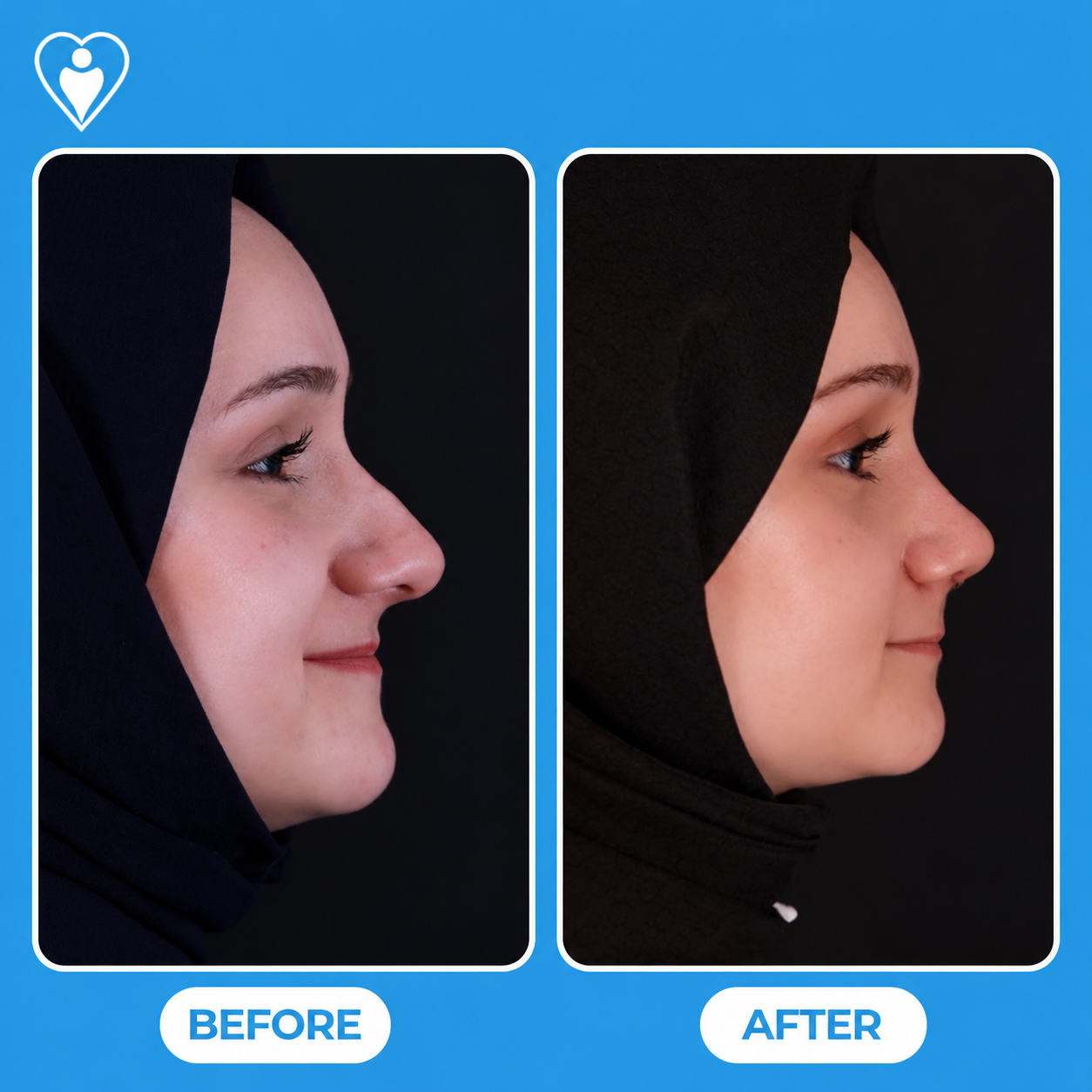 Nose surgery before and after: a woman in a hijab, side profile before, and after rhinoplasty, patient of Dr. Hasan Duygulu, Flymedi.