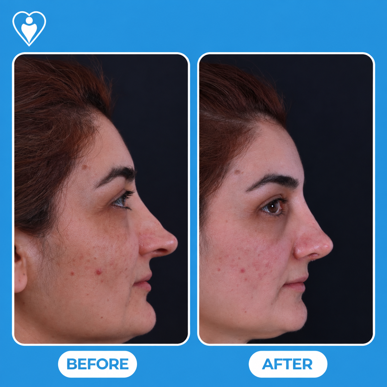 Rhinoplasty in Turkey, before and after: a woman's side profile before, and after nose reshaping, patient of Dr. Hasan Duygulu, Flymedi.