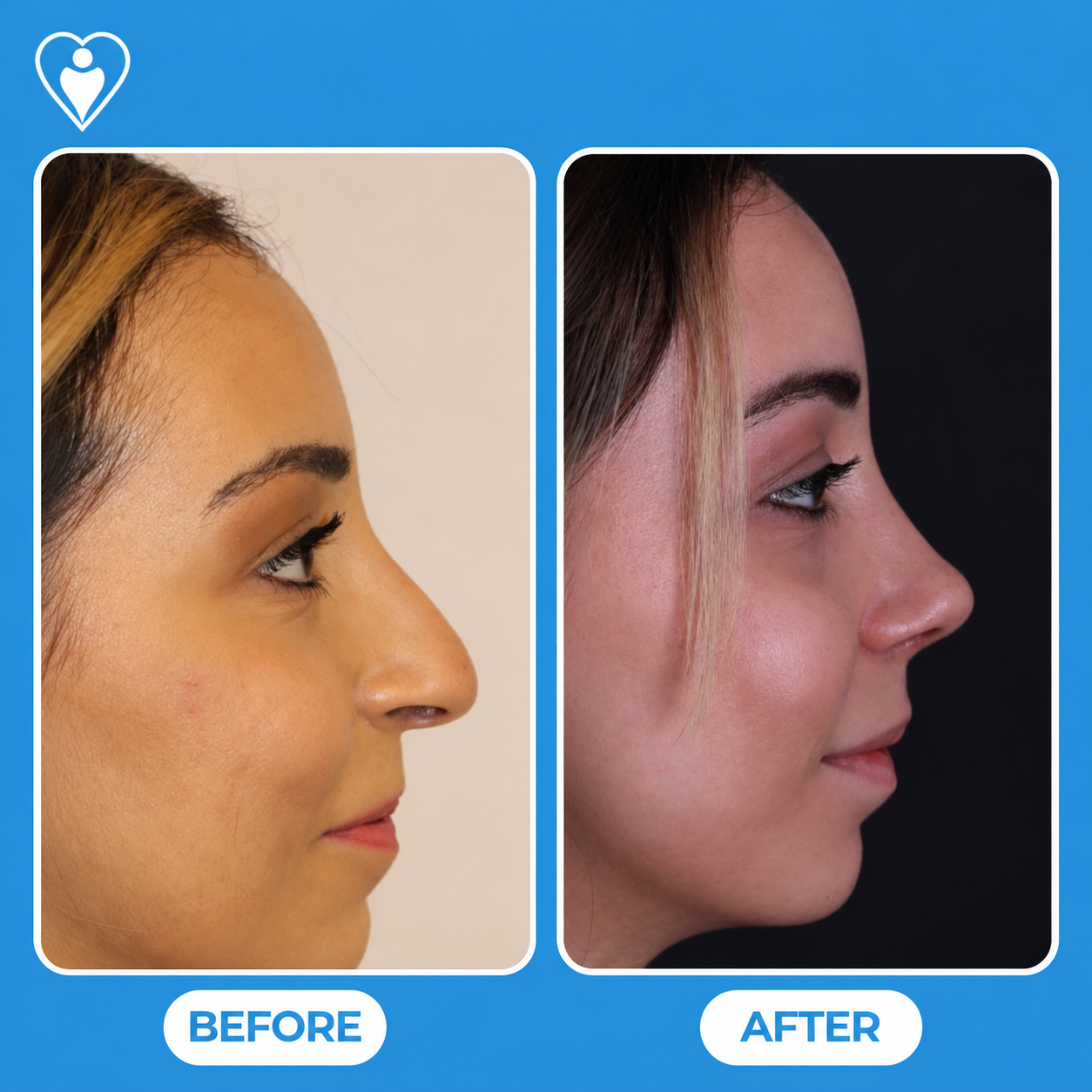 Nose reshaping surgery before and after: a woman's side profile before, and after rhinoplasty, patient of Dr. Hasan Duygulu, Flymedi.