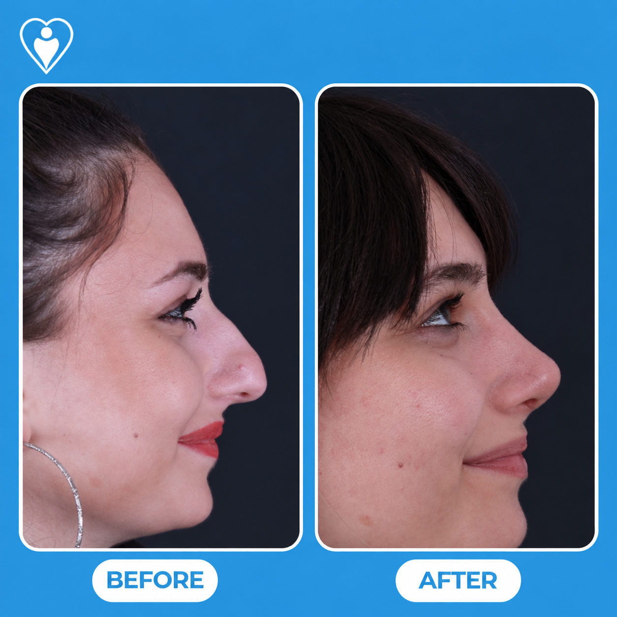 Rhinoplasty before and after: a woman with an earring, side profile before, and after nose surgery, patient of Dr. Hasan Duygulu, Flymedi.