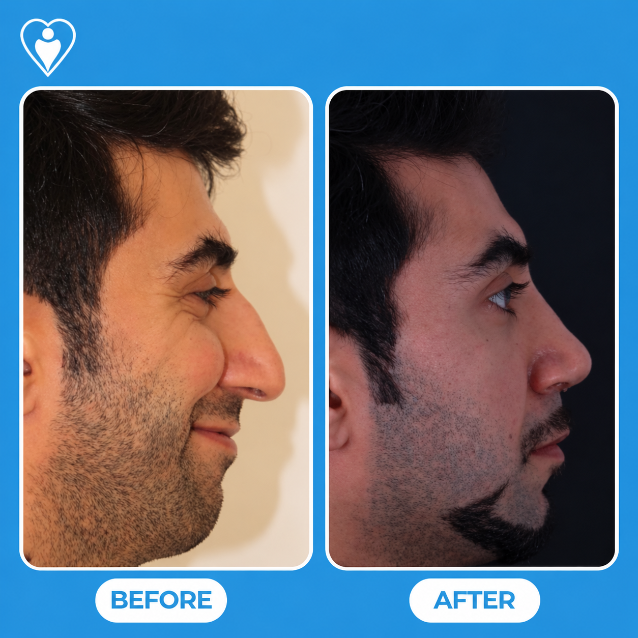 Nose surgery before and after: a bearded man's side profile before, and after rhinoplasty, patient of Dr. Hasan Duygulu, Flymedi.