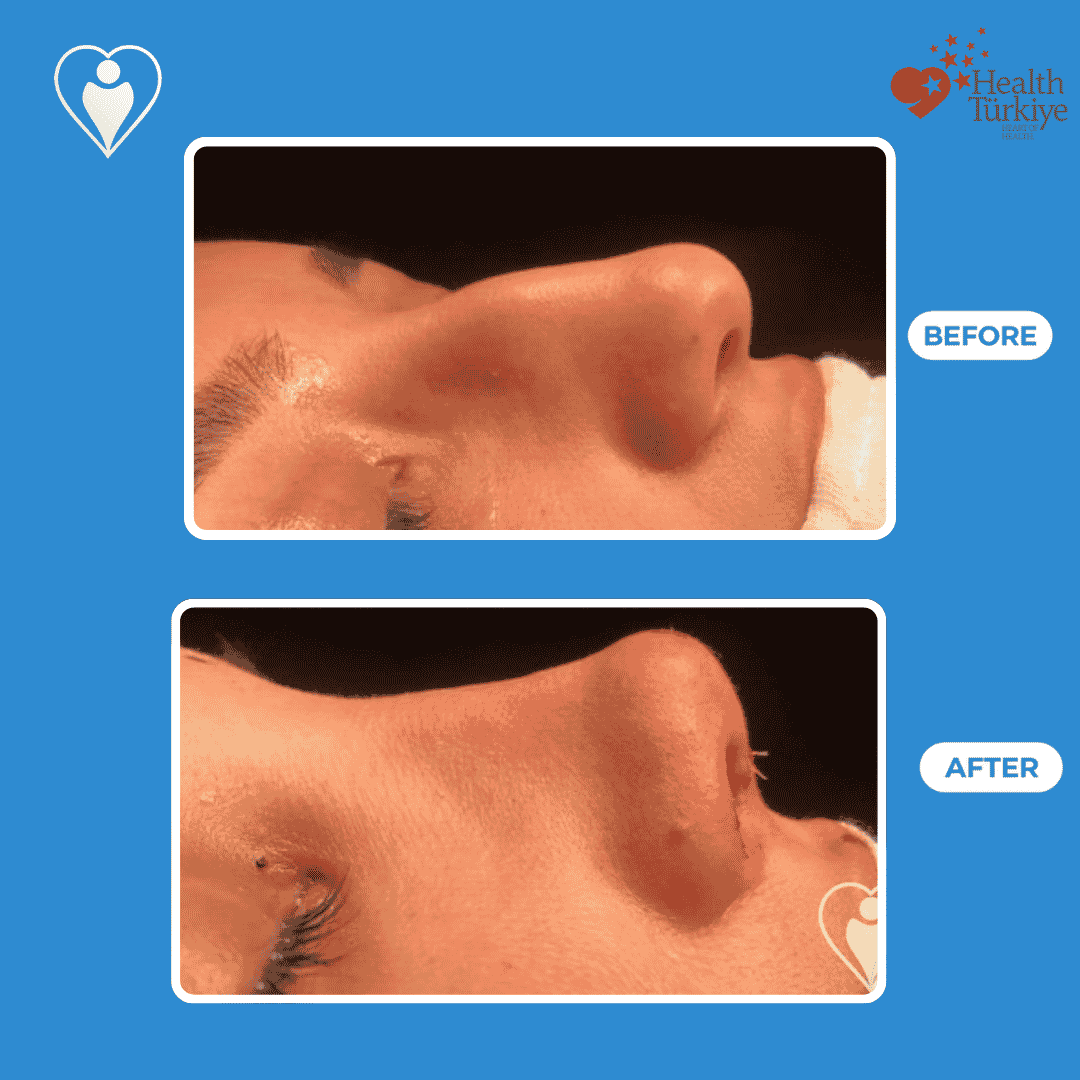 Rhinoplasty before and after: a woman's side profile before, and after nose reshaping, patient of Dr. Hasan Duygulu, Flymedi.