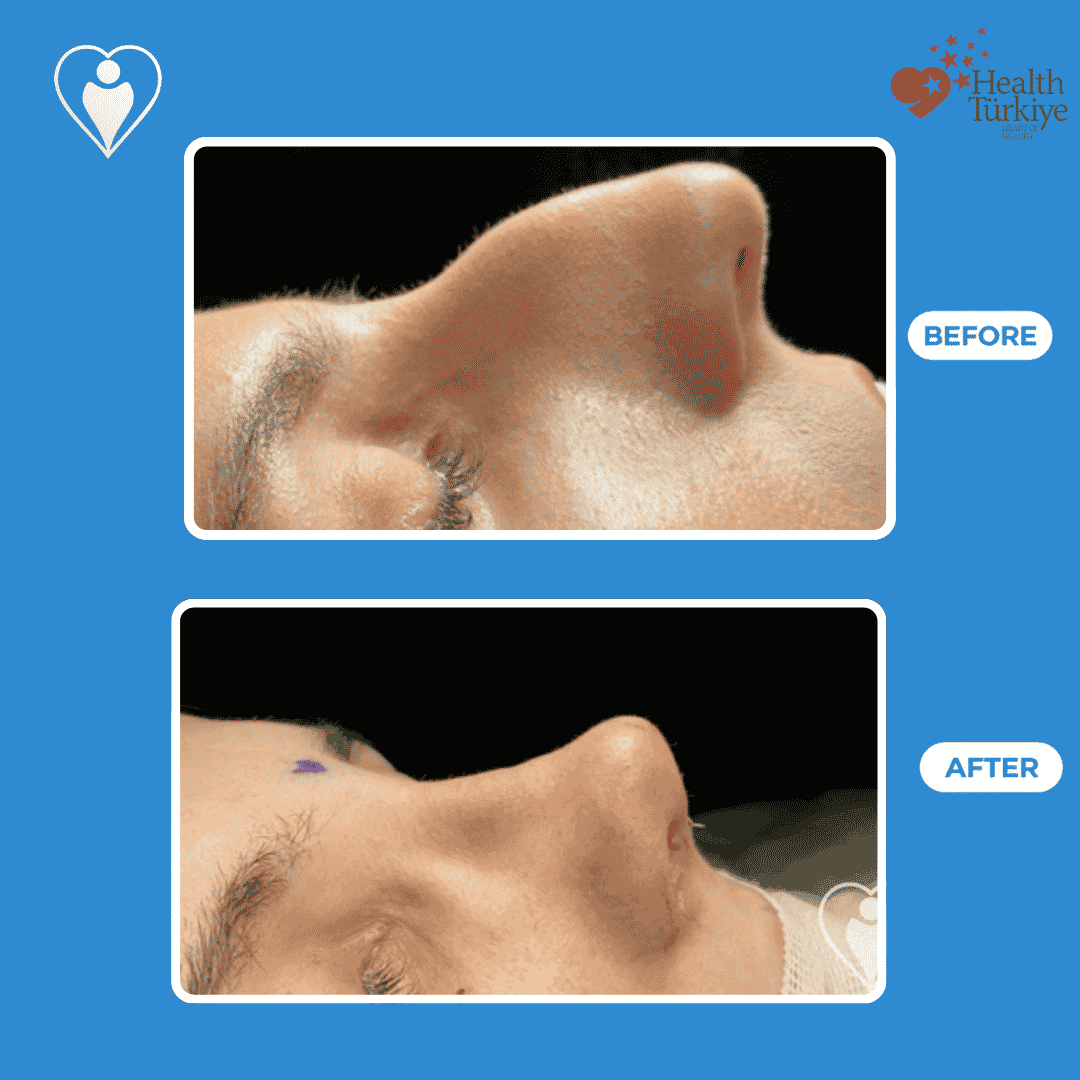 Nose surgery before and after: a man's side profile before, and after rhinoplasty, patient of Dr. Hasan Duygulu, Flymedi.