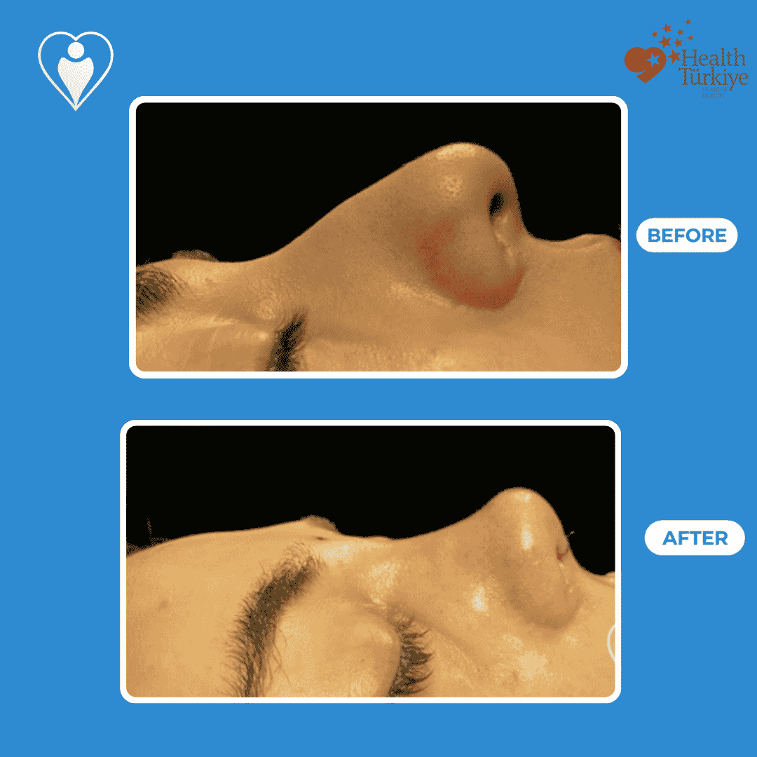 Rhinoplasty in Turkey, before and after: a close-up of a nose before surgery, and after reshaping, patient of Dr. Hasan Duygulu, Flymedi.