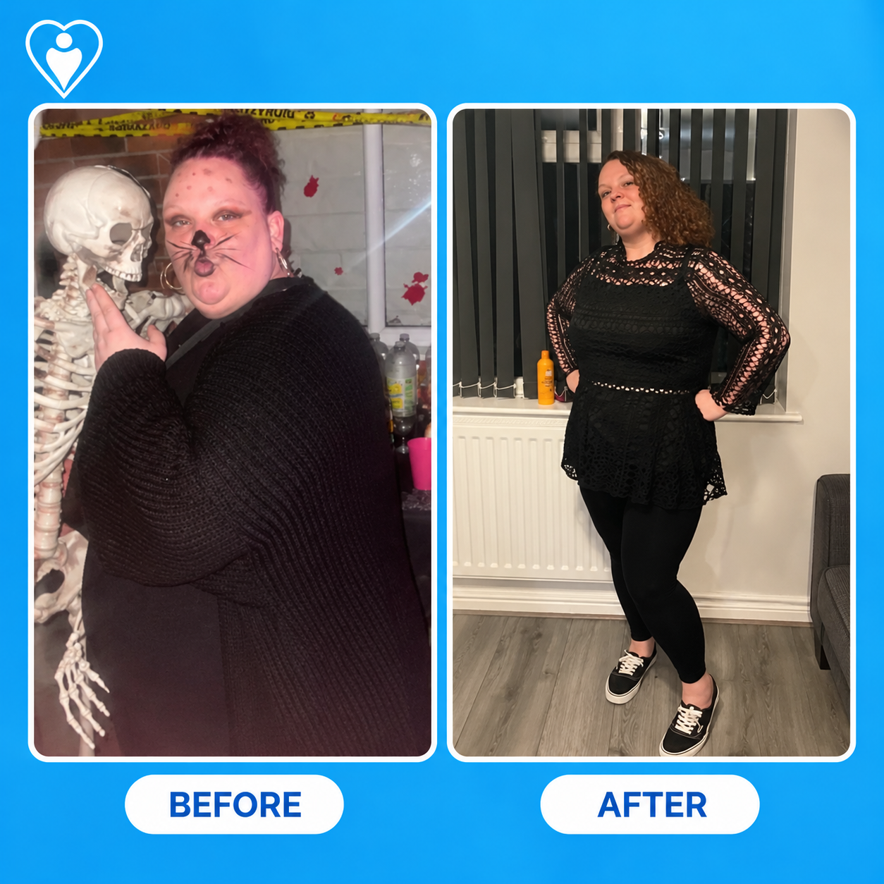 Bariatric surgery before and after: a woman before weight loss surgery, and in a lace dress after significant weight loss, patient of Dr. Hasan Liçe, Flymedi.