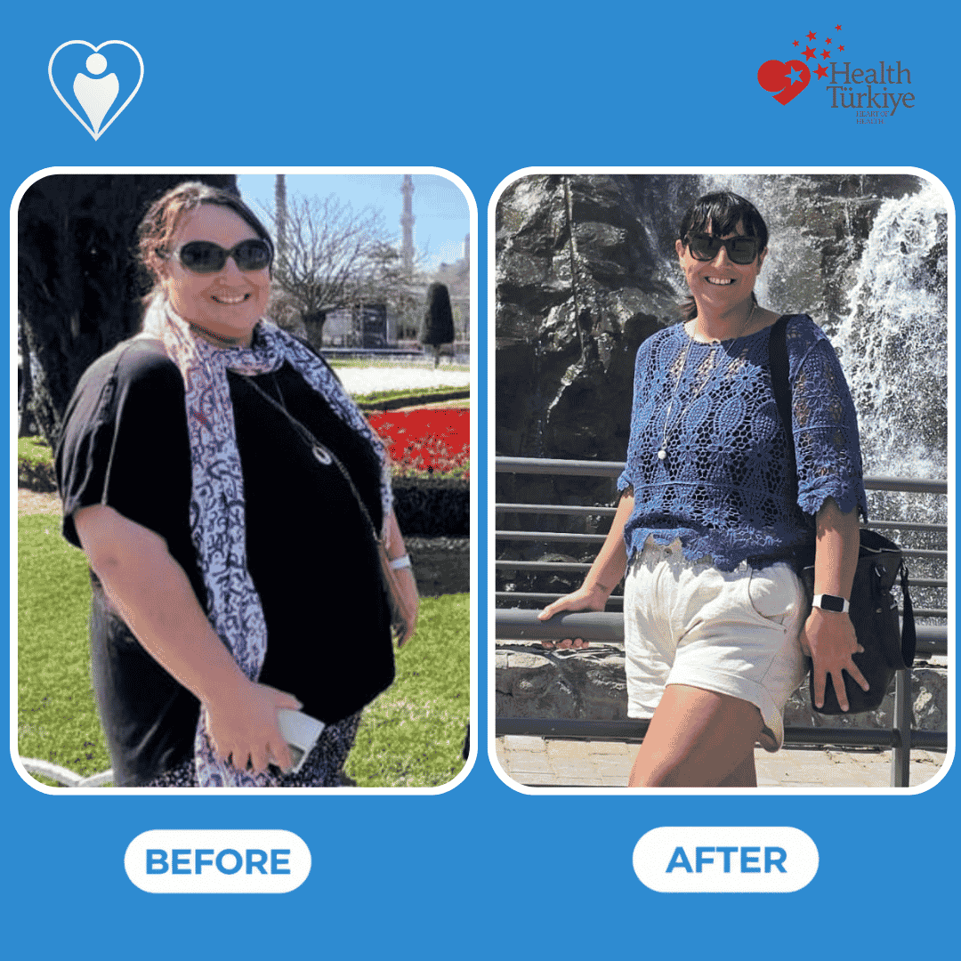 Bariatric surgery before and after: a woman in a black top and scarf outdoors before, and in a blue lace top and white shorts by a fountain after, patient of Dr. Hasan Liçe, Flymedi.