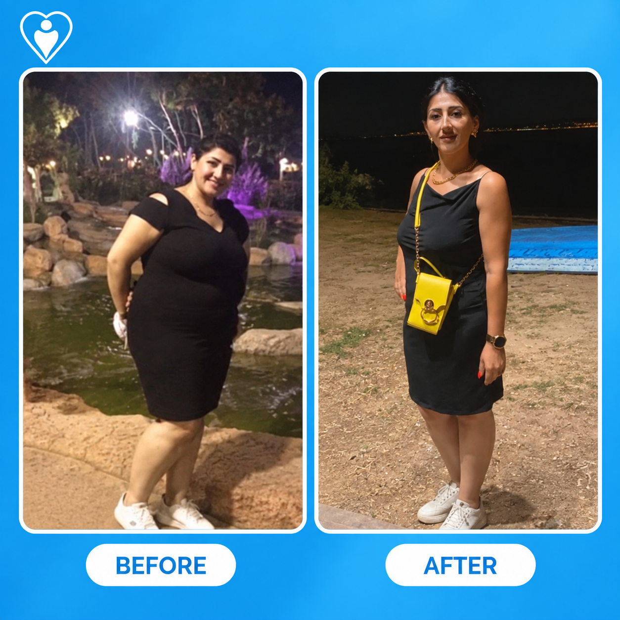 Weight loss surgery before and after: a woman in a black dress before, and after significant weight loss, patient of Dr. Hasan Liçe, Flymedi.