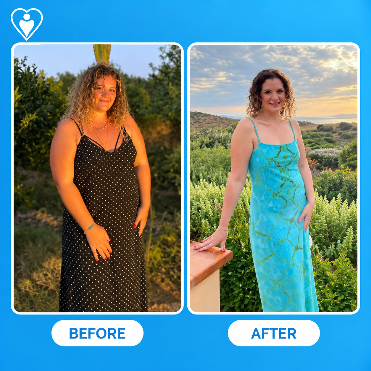 Bariatric surgery before and after: a woman in a polka dot dress before, and in a turquoise dress after weight loss, patient of Dr. Hasan Liçe, Flymedi.