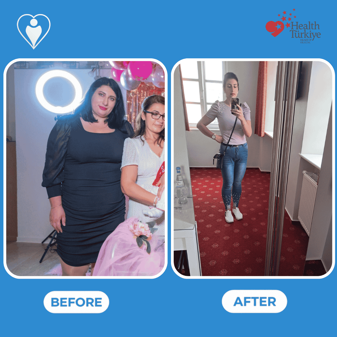 Bariatric surgery before and after: a woman in a black dress at a party before, and in a white top and jeans in a mirror selfie after, patient of Dr. Hasan Liçe, Flymedi.
