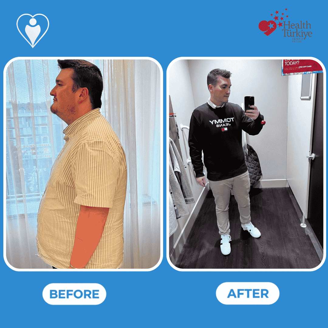 Weight loss surgery before and after: a man in a striped shirt before, and in a dark sweatshirt in a mirror selfie after, patient of Dr. Hasan Liçe, Flymedi.