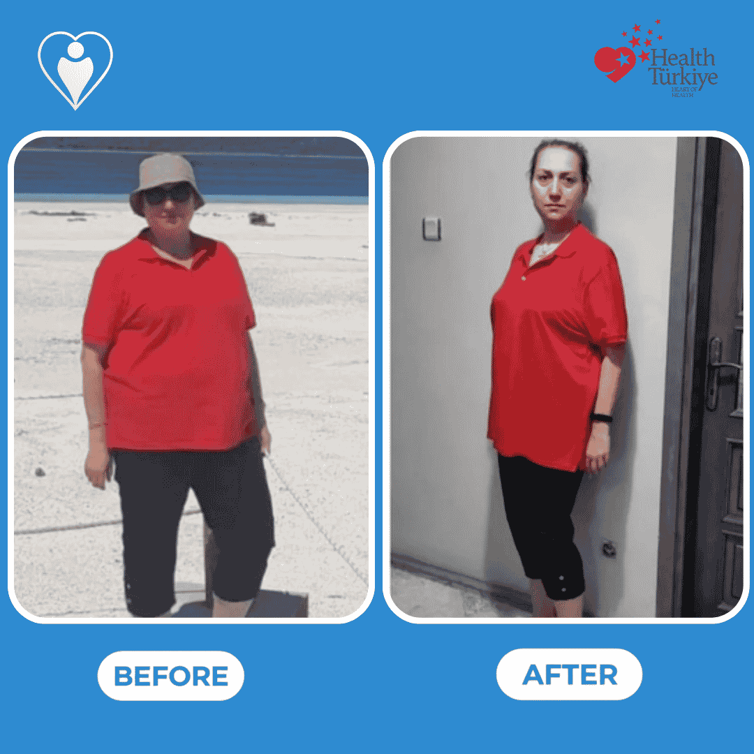 Bariatric surgery before and after: a woman in a red polo shirt and bucket hat at the beach before, and in the same red polo shirt indoors after, patient of Dr. Hasan Liçe, Flymedi.
