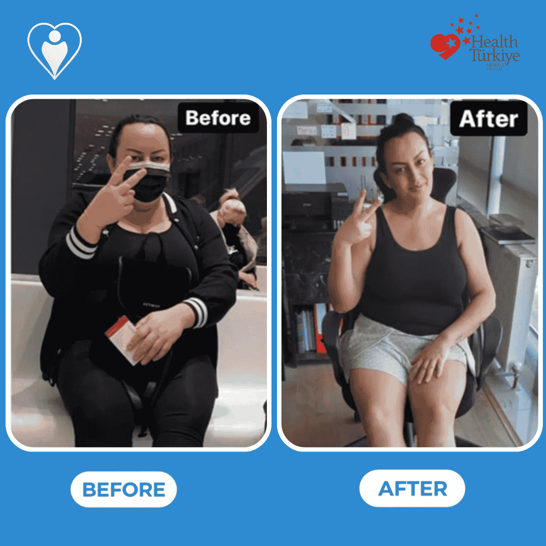 Weight loss surgery before and after: a woman in a black outfit before, and in a black tank top and shorts after, patient of Dr. Hasan Liçe, Flymedi.