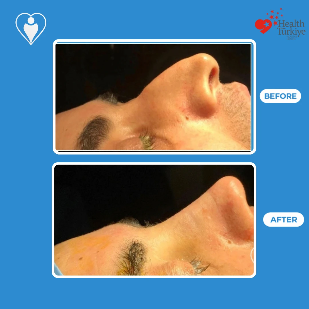 Nose surgery before and after: side profile of a man's nose on the operating table before and just after surgery, with a straighter bridge and a smaller tip, patient of Dr. Jale Özdemir, Flymedi.