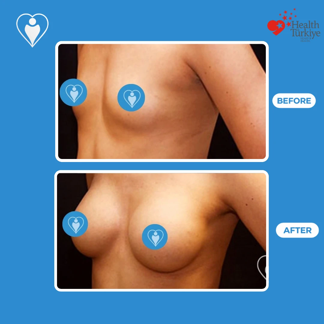Aesthetic breast surgery before and after: angled view of a woman with small breasts before and a fuller, rounder shape after, patient of Dr. Jale Özdemir, Flymedi.