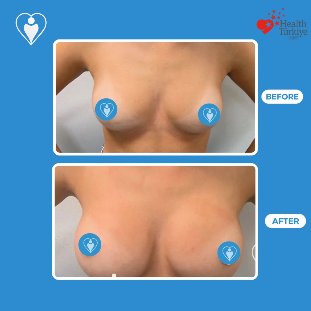 Breast plastic surgery before and after: front view of small breasts before and a fuller shape with more cleavage after, patient of Dr. Jale Özdemir, Flymedi.