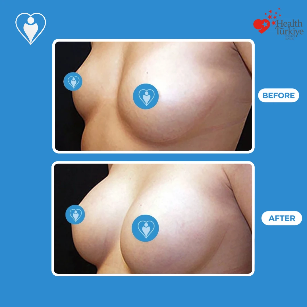 Cosmetic breast surgery in Istanbul, before and after: angled view of a woman's breasts before and a fuller, higher shape after, patient of Dr. Jale Özdemir, Flymedi.