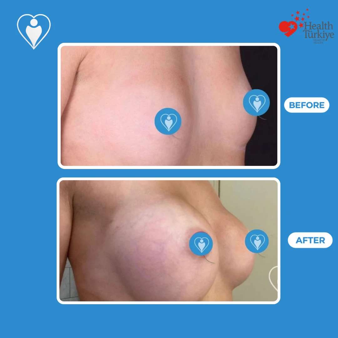 Plastic surgery before and after: angled view of a small breast before and a rounder, fuller breast after, patient of Dr. Jale Özdemir, Flymedi.