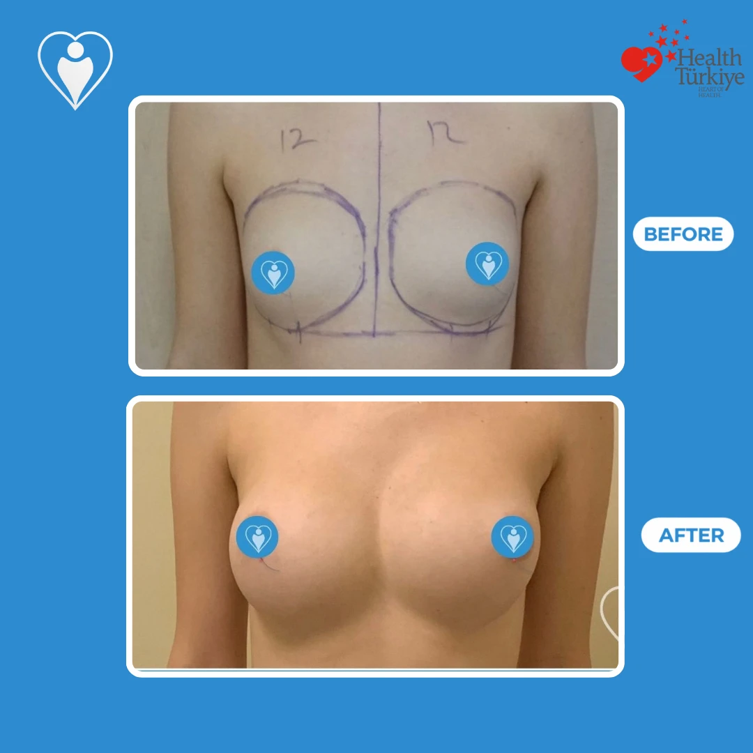 Plastic surgery in Istanbul, before and after: front view of small breasts with surgical markings before and a fuller, rounder shape after, patient of Dr. Jale Özdemir, Flymedi.