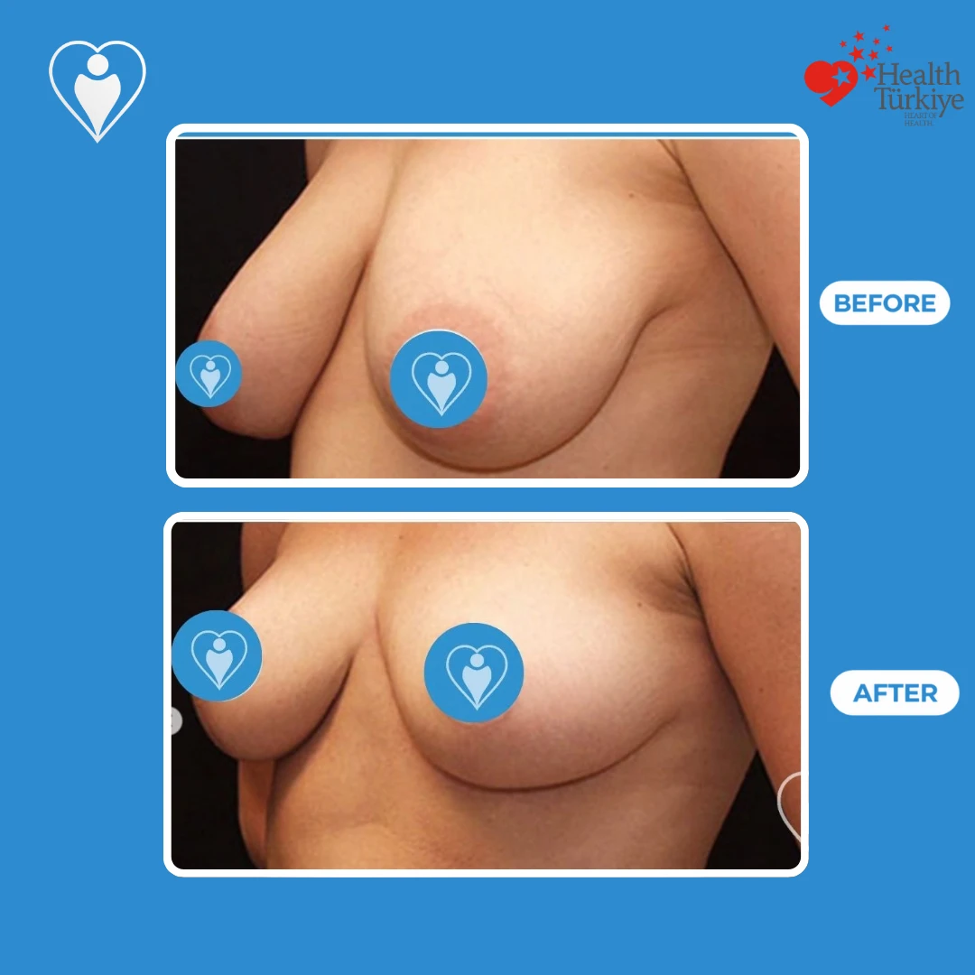 Cosmetic surgery before and after: angled view of large, sagging breasts before and a higher, firmer shape after, patient of Dr. Jale Özdemir, Flymedi.