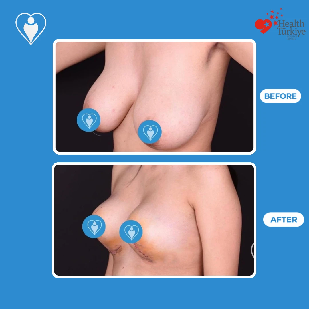 Cosmetic surgery in Turkey, before and after: angled view of heavy, sagging breasts before and a higher, fuller shape soon after surgery, with bruising, patient of Dr. Jale Özdemir, Flymedi.