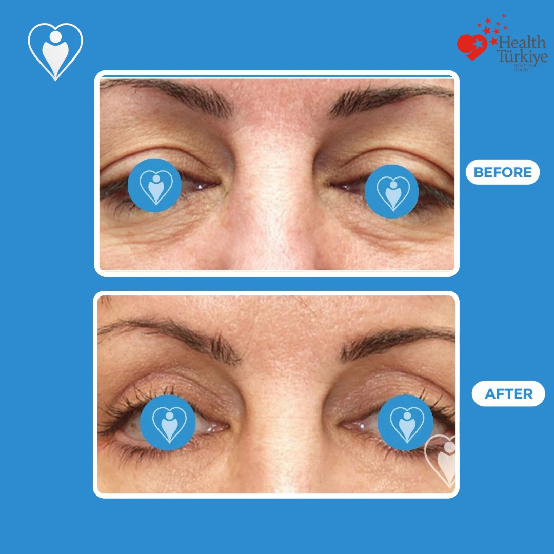 Cosmetic eye surgery before and after: close view of a woman's eyes with heavy upper lids and under eye bags before and a smoother, more open look after, patient of Dr. Jale Özdemir, Flymedi.