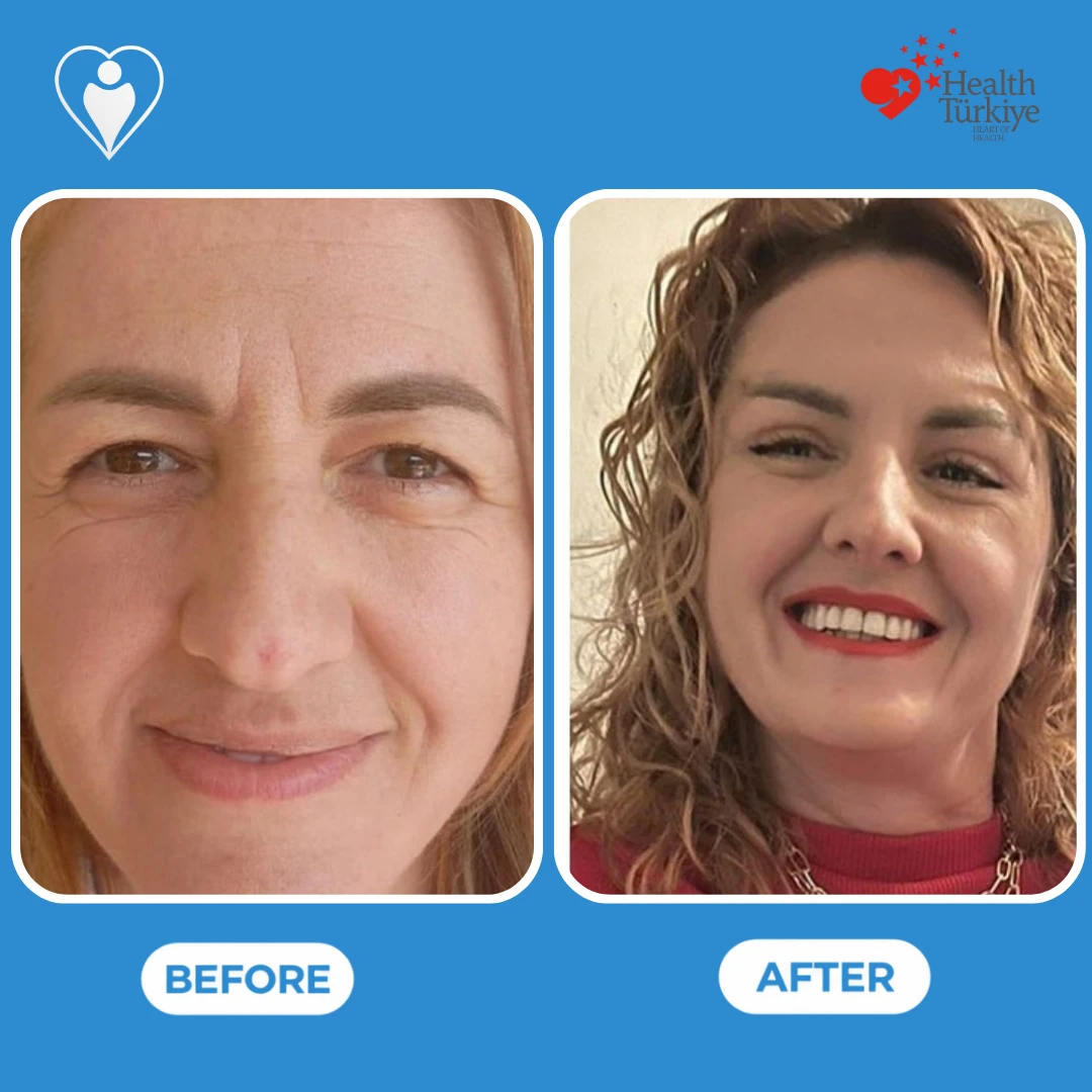 Facial surgery before and after: front view of a woman's face with forehead lines and wrinkles around the eyes before and a smoother face after, patient of Dr. Jale Özdemir, Flymedi.