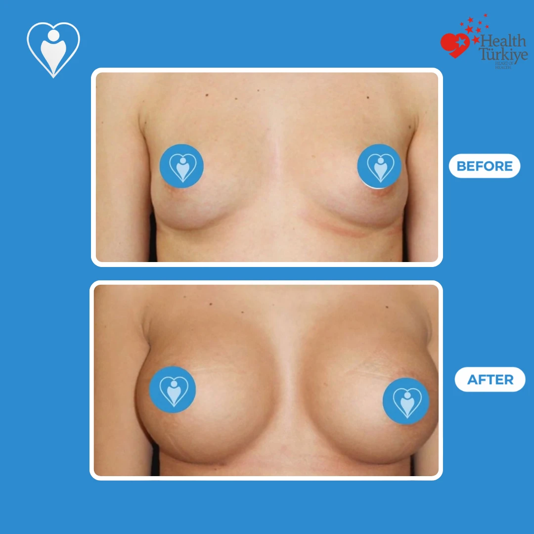 Breast surgery before and after: front view of small, wide set breasts before and a fuller, rounder shape after, nipples covered, patient of Dr. Jale Özdemir, Flymedi.
