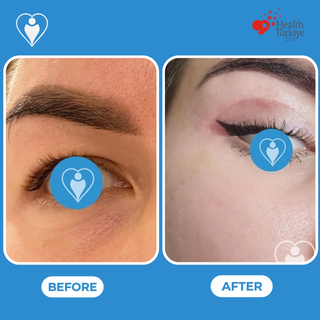 Cosmetic eye surgery in Turkey, before and after: close view of a woman's eye before and soon after surgery, with light redness on the upper lid, patient of Dr. Jale Özdemir, Flymedi.