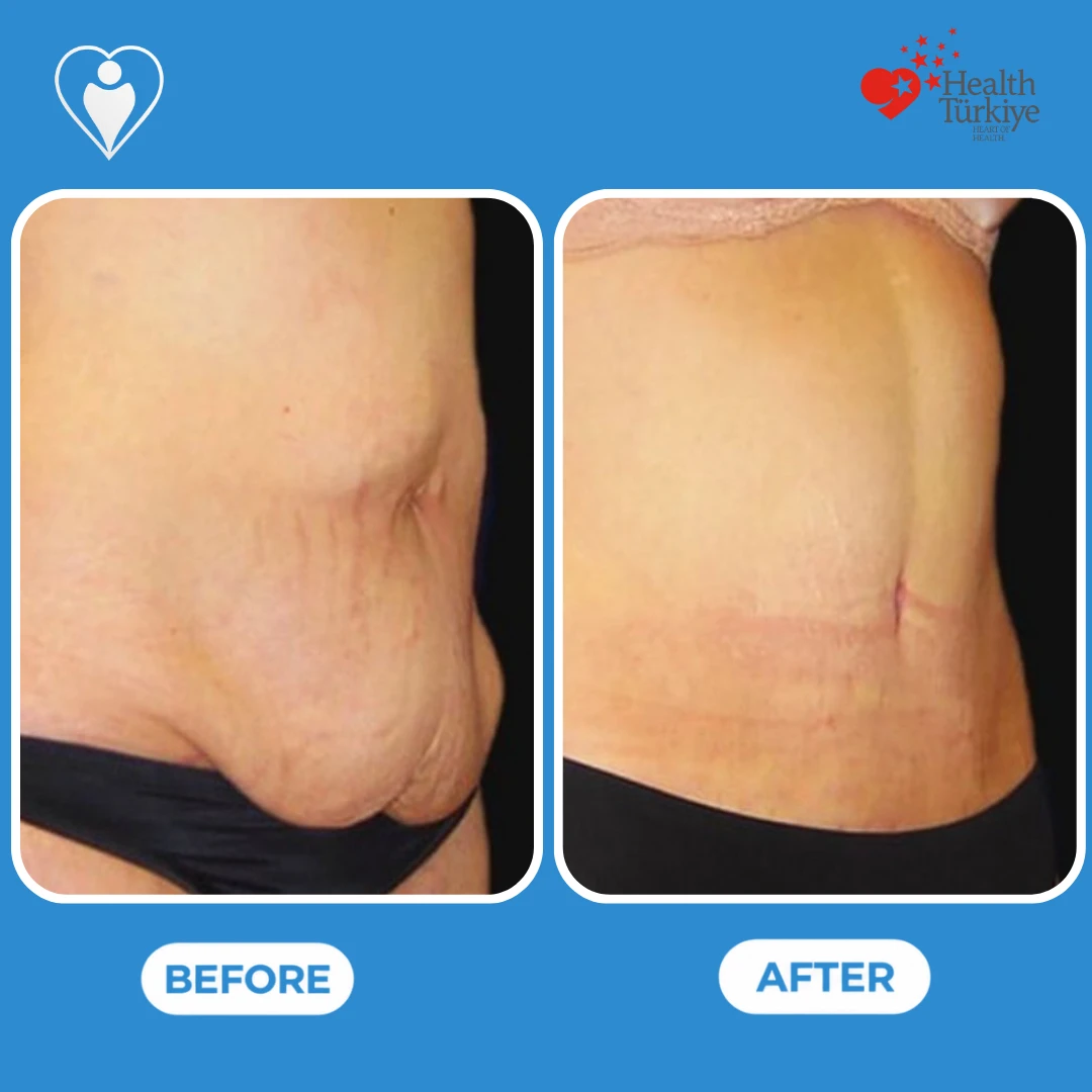 Abdominal surgery before and after: side view of a woman's abdomen with loose skin and stretch marks before and a flatter abdomen after, with a fine scar, patient of Dr. Jale Özdemir, Flymedi.