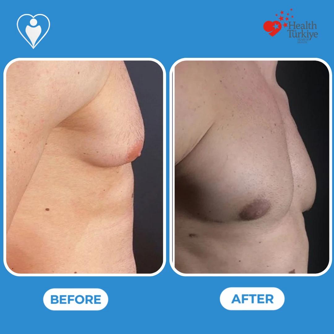 Male chest surgery before and after: side view of a man's chest with enlarged breast tissue before and a flatter contour after, patient of Dr. Jale Özdemir, Flymedi.