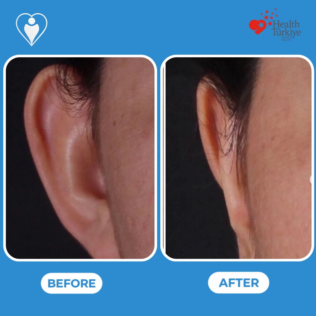Ear surgery before and after: close view of a prominent ear before and an ear sitting closer to the head after, patient of Dr. Jale Özdemir, Flymedi.