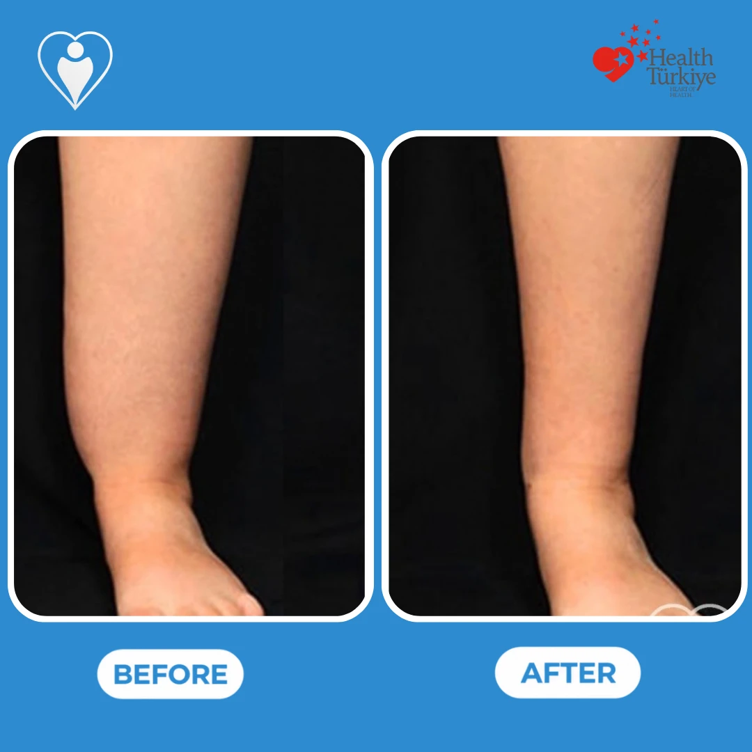 Leg contouring before and after: view of a lower leg and ankle before and a slimmer ankle line after, patient of Dr. Jale Özdemir, Flymedi.