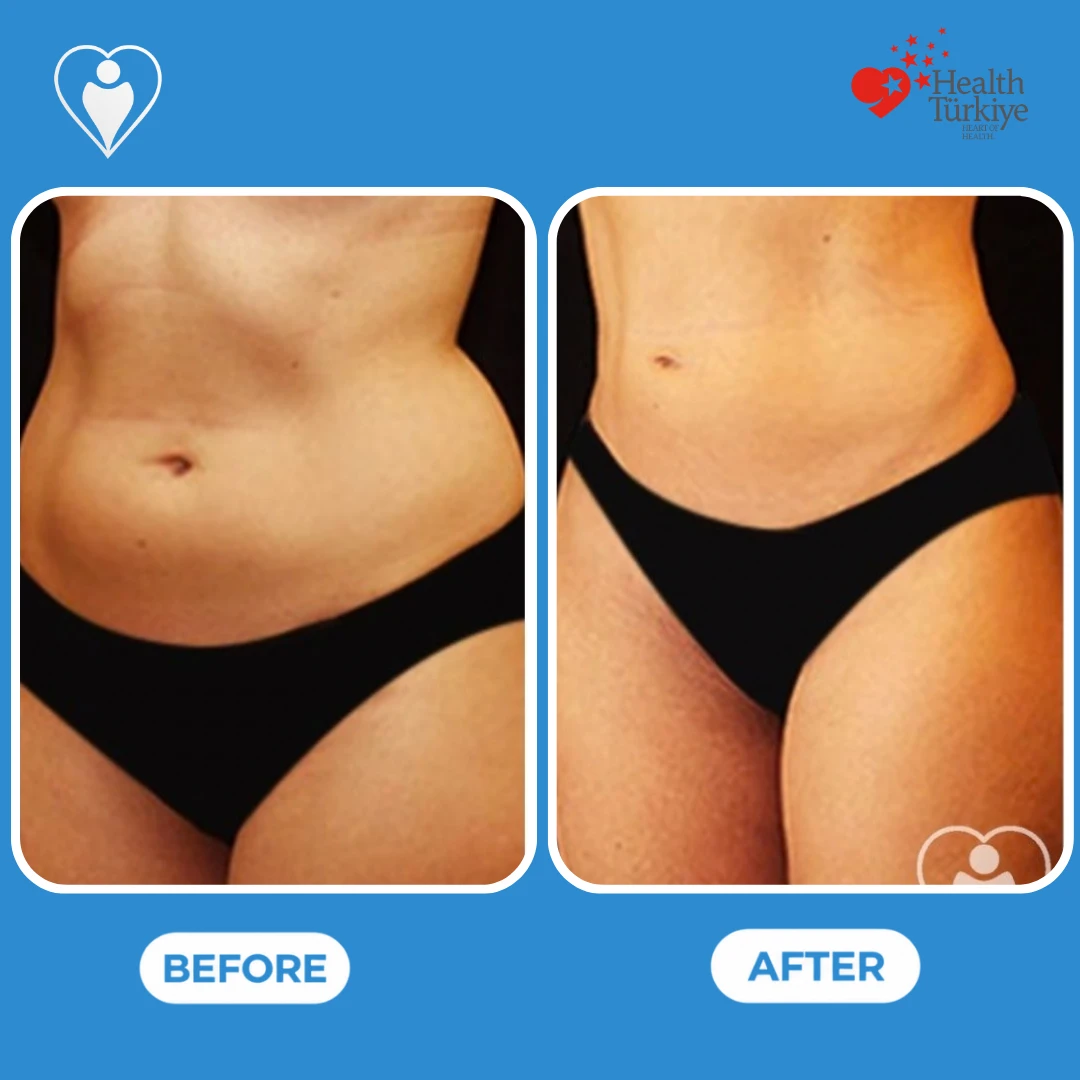 Body contouring before and after: front view of a woman's waist and hips before and a slimmer, smoother contour after, patient of Dr. Jale Özdemir, Flymedi.