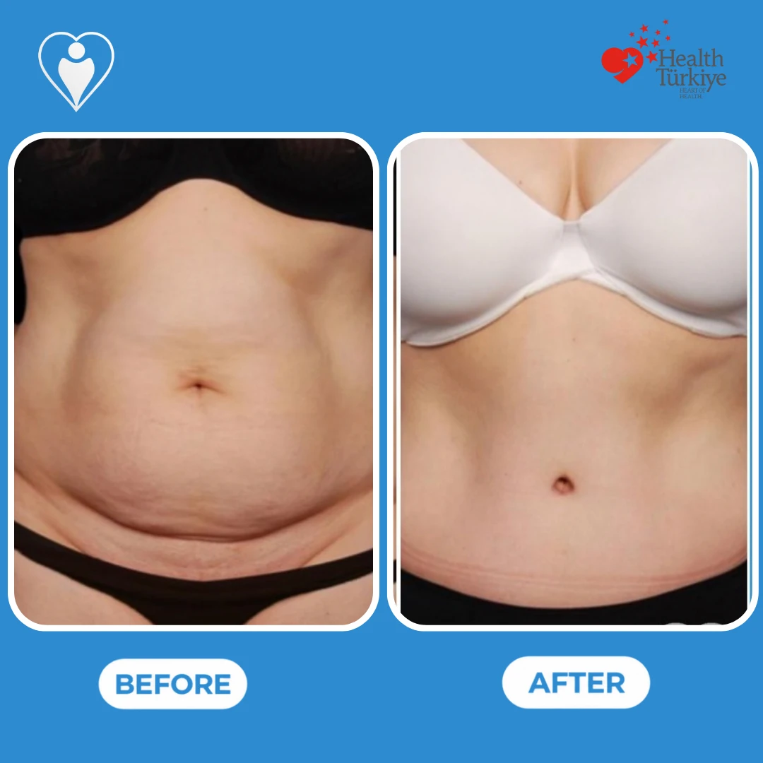 Abdominal surgery in Istanbul, before and after: front view of a woman's abdomen with loose skin before and a flatter, firmer abdomen after, patient of Dr. Jale Özdemir, Flymedi.